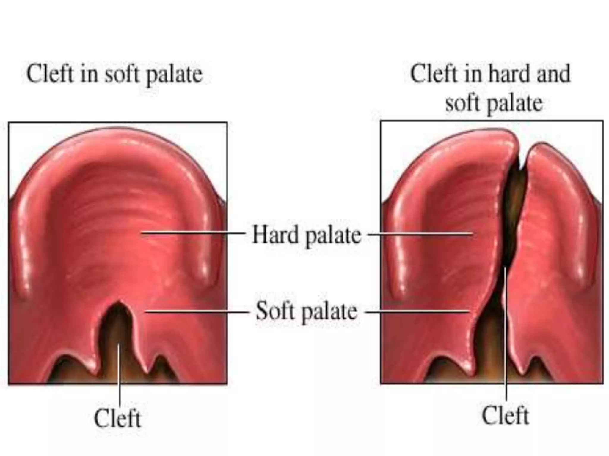 Cleft lip and cleft palate | PPTX