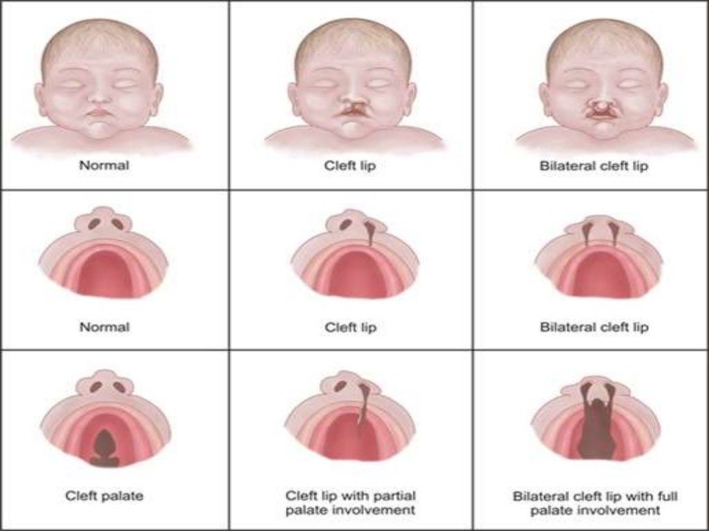 Cleft lip and cleft palate