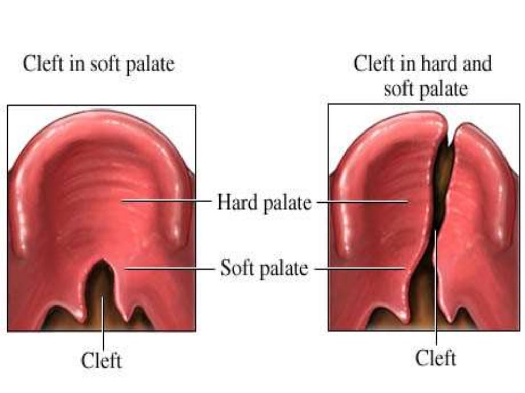 Cleft lip and cleft palate