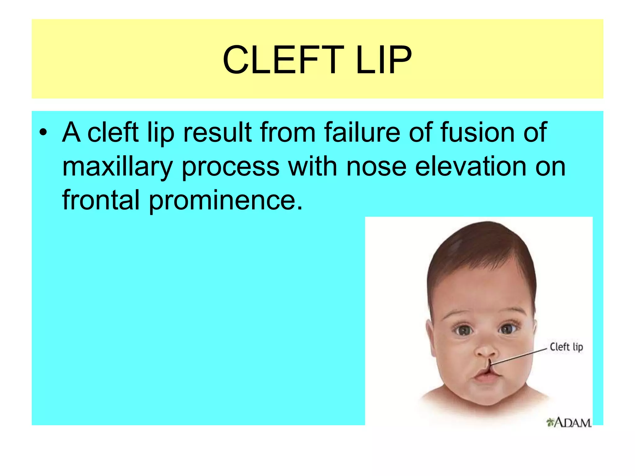 Cleft lip and cleft palate.ppt