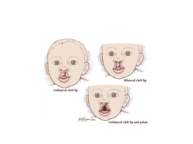 CLEFT LIP AND CLEFT PALATE.pptx in children | PPTX