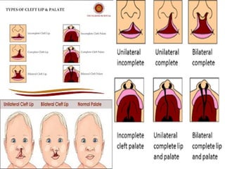 Comprehensive Overview of Cleft Lip and Cleft Palate: Causes ...