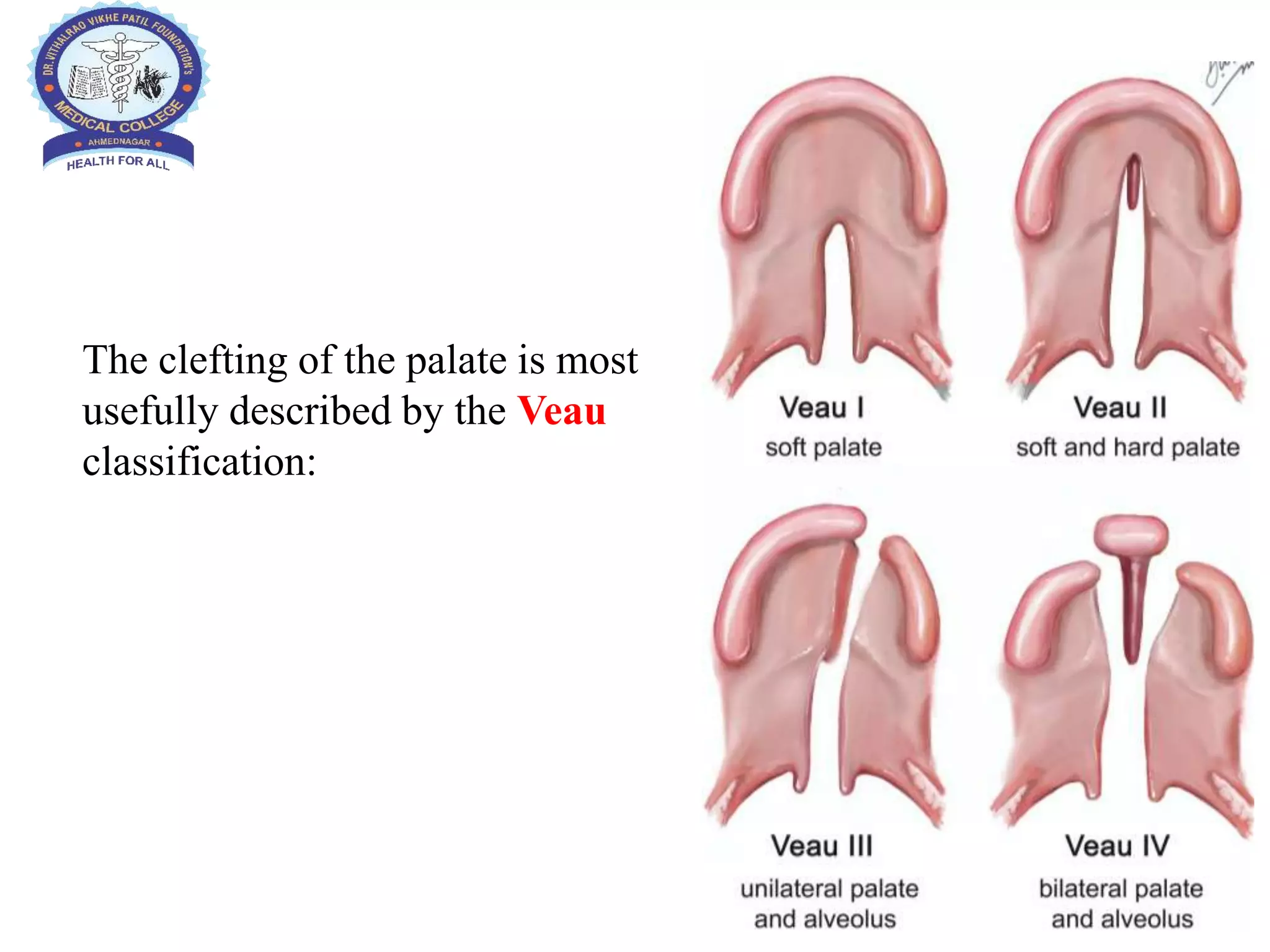 Veau Classfication Cleft lip and cleft palate in children | PPTX