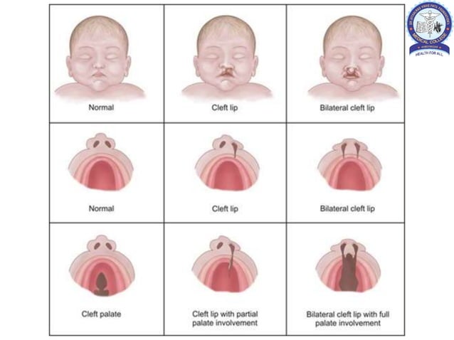Cleft lip and cleft palate in children | PPTX | Pregnancy ...