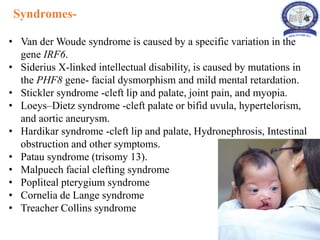 Cleft lip and cleft palate in children | PPTX