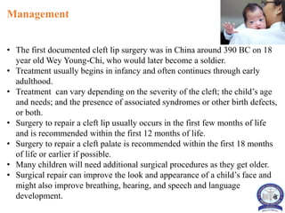 Cleft lip and cleft palate in children | PPTX