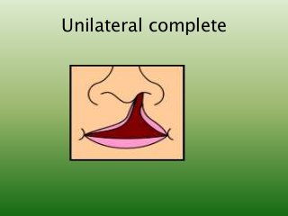Unilateral complete
 