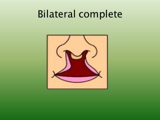 Bilateral complete
 