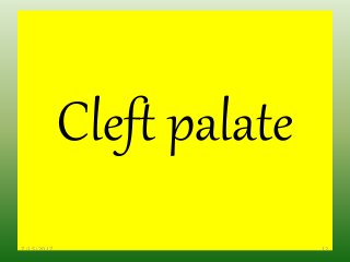 Cleft palate
7/15/2017 12
 
