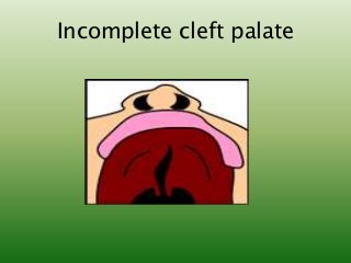 Incomplete cleft palate
 