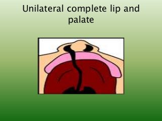 Unilateral complete lip and
palate
 
