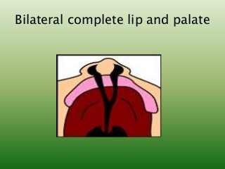 Bilateral complete lip and palate
 