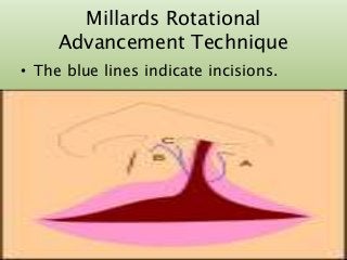 Millards Rotational
Advancement Technique
• The blue lines indicate incisions.
7/15/2017 33
 