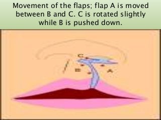 Movement of the flaps; flap A is moved
between B and C. C is rotated slightly
while B is pushed down.
7/15/2017 34
 