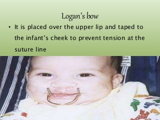 Logan’s bow
• It is placed over the upper lip and taped to
the infant’s cheek to prevent tension at the
suture line
7/15/2017 44
 