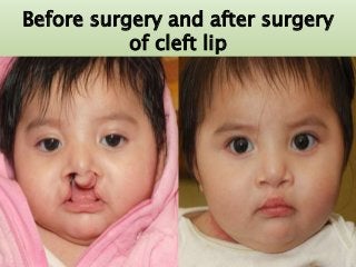 Before surgery and after surgery
of cleft lip
7/15/2017 8
 