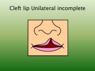 Cleft lip Unilateral incomplete
 