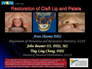 Restoration of Cleft Lip and Palate




                                   Arun Sharma DDS
    Department of Preventive and Restorative Dentistry, UCSF
                          John Beumer III, DDS, MS
                            Ting Ling Chang, DDS
                     Division of Advanced Prosthodontics, UCLA
*The material in this program of instruction is protected by copyright ©. No
part of this program of instruction may be produced, recorded, or
transmitted by any means, electronic,digital, photographic, mechanical etc.
or by any information storage or retrieval system, without prior permission.
 