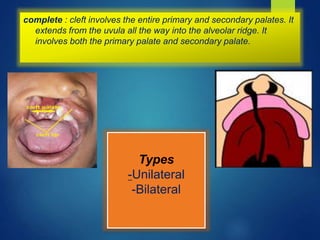 Cleft lip and palate | PPTX