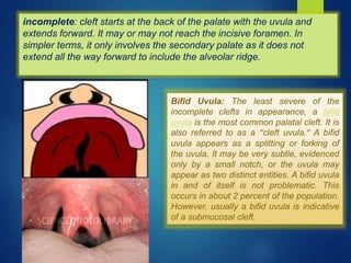 Cleft lip and palate | PPTX