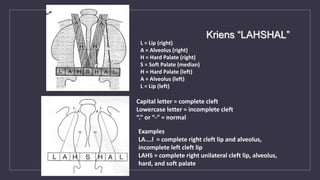 Kriens “LAHSHAL”
L = Lip (right)
A = Alveolus (right)
H = Hard Palate (right)
S = Soft Palate (median)
H = Hard Palate (left)
A = Alveolus (left)
L = Lip (left)
Capital letter = complete cleft
Lowercase letter = incomplete cleft
“.” or “-” = normal
Examples
LA….l = complete right cleft lip and alveolus,
incomplete left cleft lip
LAHS = complete right unilateral cleft lip, alveolus,
hard, and soft palate
 