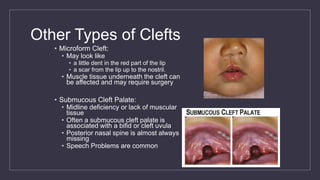 Other Types of Clefts
• Microform Cleft:
• May look like
• a little dent in the red part of the lip
• a scar from the lip up to the nostril.
• Muscle tissue underneath the cleft can
be affected and may require surgery
• Submucous Cleft Palate:
• Midline deficiency or lack of muscular
tissue
• Often a submucous cleft palate is
associated with a bifid or cleft uvula
• Posterior nasal spine is almost always
missing
• Speech Problems are common
 