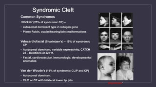 Syndromic Cleft
Common Syndromes
Stickler (25% of syndromic CP) –
• autosomal dominant type 2 collagen gene
• Pierre Robin, ocular/hearing/joint malformations
Velocardiofacial (Shprintzen’s) – 15% of syndromic
CP
• Autosomal dominant, variable expressivity, CATCH
22 – Deletions at 22q11,
• Facial, cardiovascular, immunologic, developmental
anomalies
Van der Woude’s (19% of syndromic CL/P and CP)
• Autosomal dominant
• CL/P or CP with bilateral lower lip pits
Shprintzen’
 