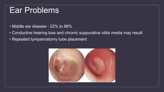 Ear Problems
• Middle ear disease - 22% to 88%
• Conductive hearing loss and chronic suppurative otitis media may result
• Repeated tympanostomy tube placement
 