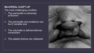 BILATERAL CLEFT LIP
The most challenging condition
1. The premaxilla is extremely
protrusive
2. The premaxilla and prolabium can
be of variable size
3. The columella is deficient/almost
nonexistent
4. The palatal shelves are collapsed
 