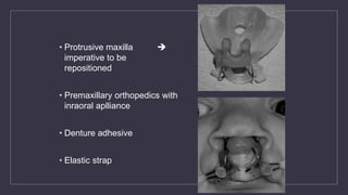 • Protrusive maxilla 
imperative to be
repositioned
• Premaxillary orthopedics with
inraoral aplliance
• Denture adhesive
• Elastic strap
 