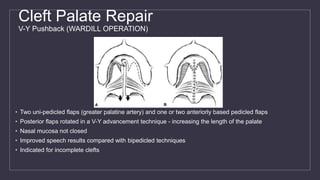 Cleft Palate Repair
V-Y Pushback (WARDILL OPERATION)
• Two uni-pedicled flaps (greater palatine artery) and one or two anteriorly based pedicled flaps
• Posterior flaps rotated in a V-Y advancement technique - increasing the length of the palate
• Nasal mucosa not closed
• Improved speech results compared with bipedicled techniques
• Indicated for incomplete clefts
 