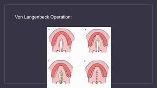 Von Langenbeck Operation:
 