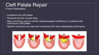 Cleft Palate Repair
Furlow Palatoplasty
• Lengthens the soft palate
• Reconstructs the muscle sling.
• Also commonly used to correct velopharyngeal insufficiency in patients with
submucous cleft palate
• Speech outcomes are improved compared with other palatoplasty techniques.
 