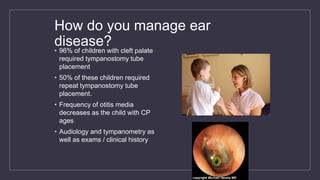 How do you manage ear
disease?• 96% of children with cleft palate
required tympanostomy tube
placement
• 50% of these children required
repeat tympanostomy tube
placement.
• Frequency of otitis media
decreases as the child with CP
ages
• Audiology and tympanometry as
well as exams / clinical history
 