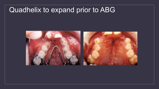 Quadhelix to expand prior to ABG
 