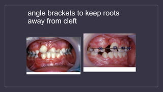 angle brackets to keep roots
away from cleft
 
