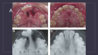 Alveolar Bone Grafting
 