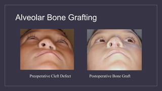 Alveolar Bone Grafting
Preoperative Cleft Defect Postoperative Bone Graft
 