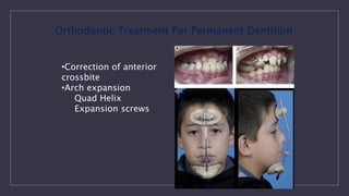 •Correction of anterior
crossbite
•Arch expansion
Quad Helix
Expansion screws
Orthodontic Treatment For Permanent Dentition
 