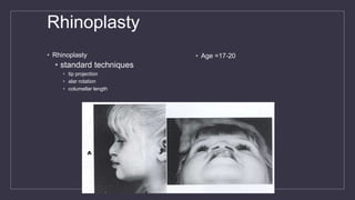 Rhinoplasty
• Rhinoplasty
• standard techniques
• tip projection
• alar rotation
• columellar length
• Age =17-20
 