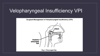 Velopharyngeal Insufficiency VPI
 