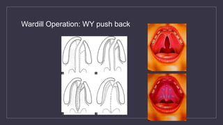 Wardill Operation: WY push back
 