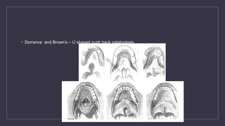 • Dorrance and Brown’s – U shaped push back palatoplasty
 