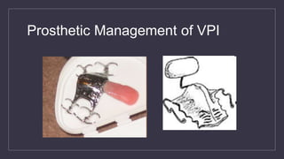 Prosthetic Management of VPI
 
