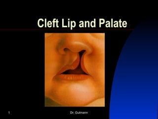 Dr. Gutmann1
Cleft Lip and Palate
 