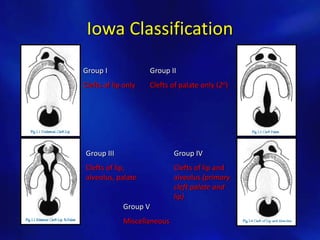 Iowa Classification 
Group I 
Clefts of lip only 
Group II 
Clefts of palate only (2o) 
Group III 
Clefts of lip, 
alveolus, palate 
Group IV 
Clefts of lip and 
alveolus (primary 
cleft palate and 
lip) 
Group V 
Miscellaneous 
 