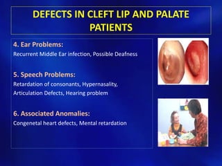 DEFECTS IN CLEFT LIP AND PALATE 
PATIENTS 
4. Ear Problems: 
Recurrent Middle Ear infection, Possible Deafness 
5. Speech Problems: 
Retardation of consonants, Hypernasality, 
Articulation Defects, Hearing problem 
6. Associated Anomalies: 
Congenetal heart defects, Mental retardation 
 