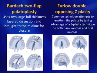 Furlow double-opposing 
Z plasty 
Common technique attempts to 
lengthen the palate by taking 
advantage of a Z-plasty technique 
on both nasal mucosa and oral 
mucosa. 
Bardach two-flap 
palatoplasty 
Uses two large full thickness 
layered dissection and 
brought to the midline for 
closure 
 