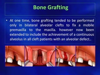 Bone Grafting 
• At one time, bone grafting tended to be performed 
only in bilateral alveolar clefts to fix a mobile 
premaxilla to the maxilla. however now been 
extended to include the achievement of a continuous 
alveolus in all cleft patients with an alveolar defect.. 
 