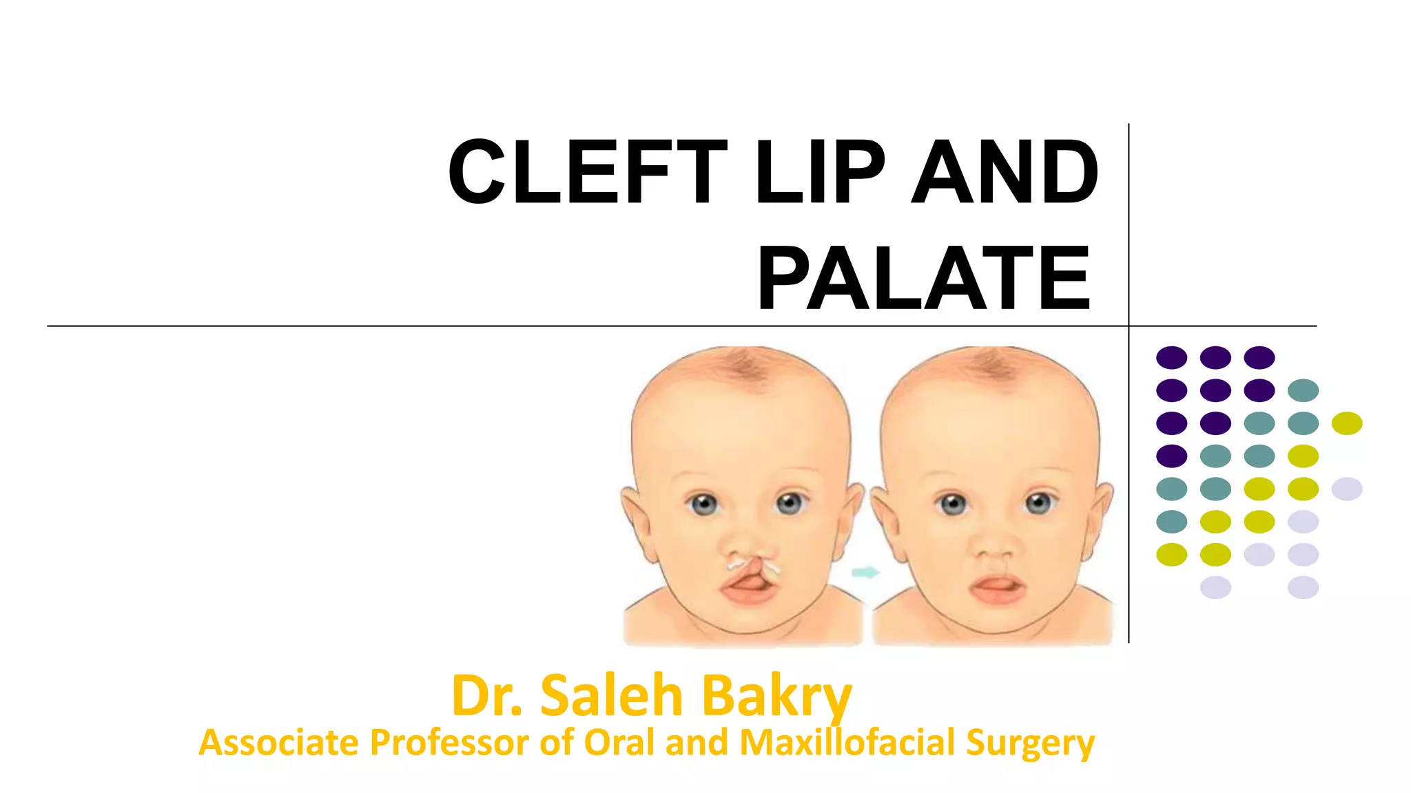 Cleft lip and palate | PPT